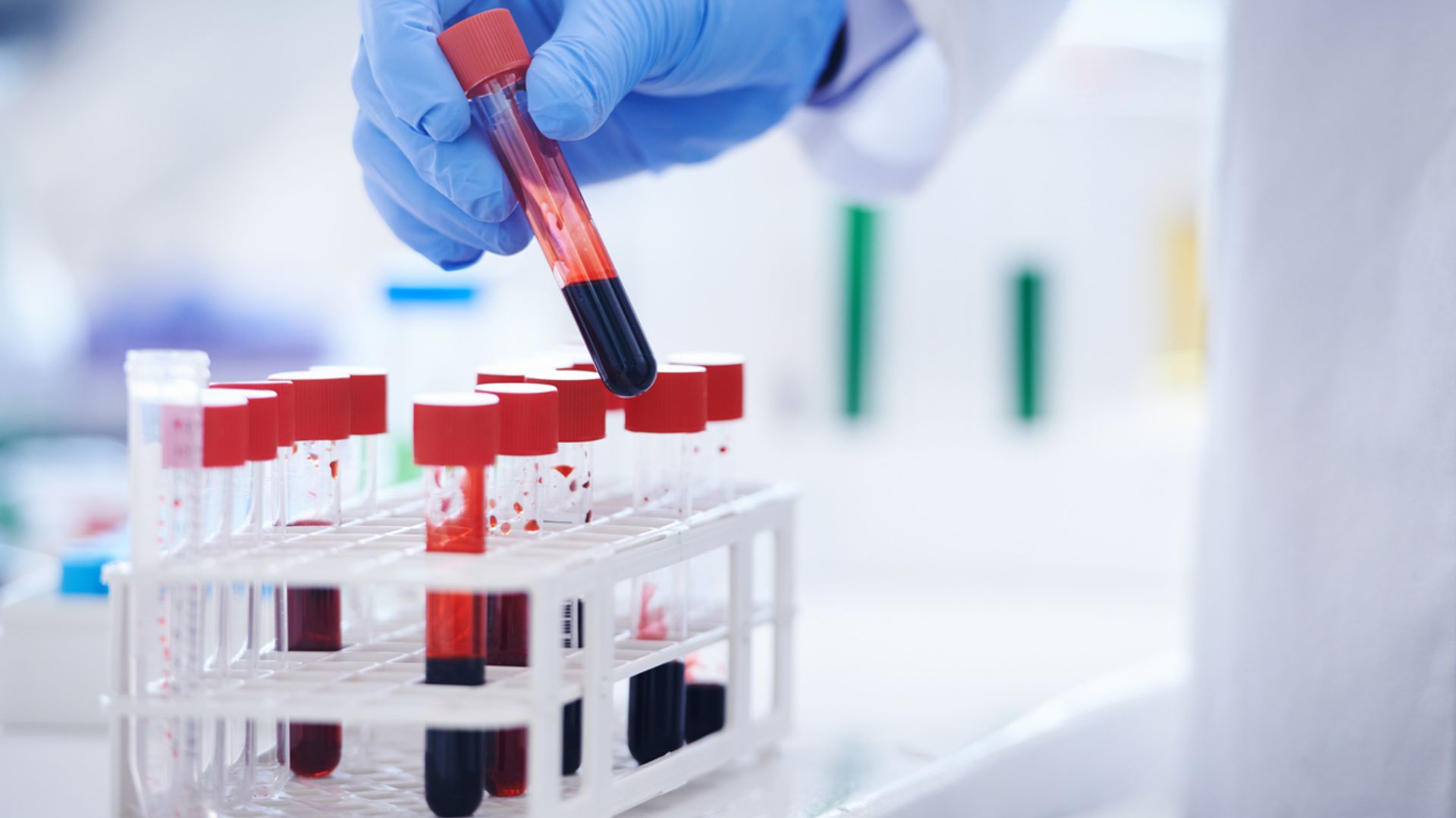 Blood test could 'revolutionise' Alzheimer's diagnosis