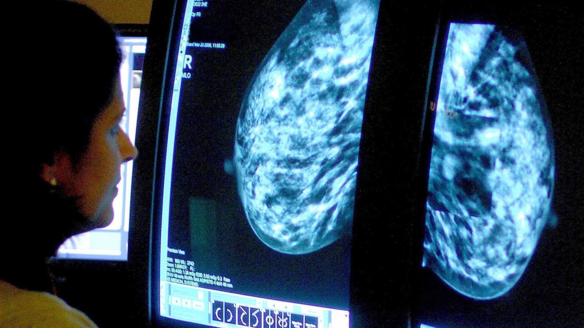 AI mammograms result in fewer aggressive breast cancers, study suggests