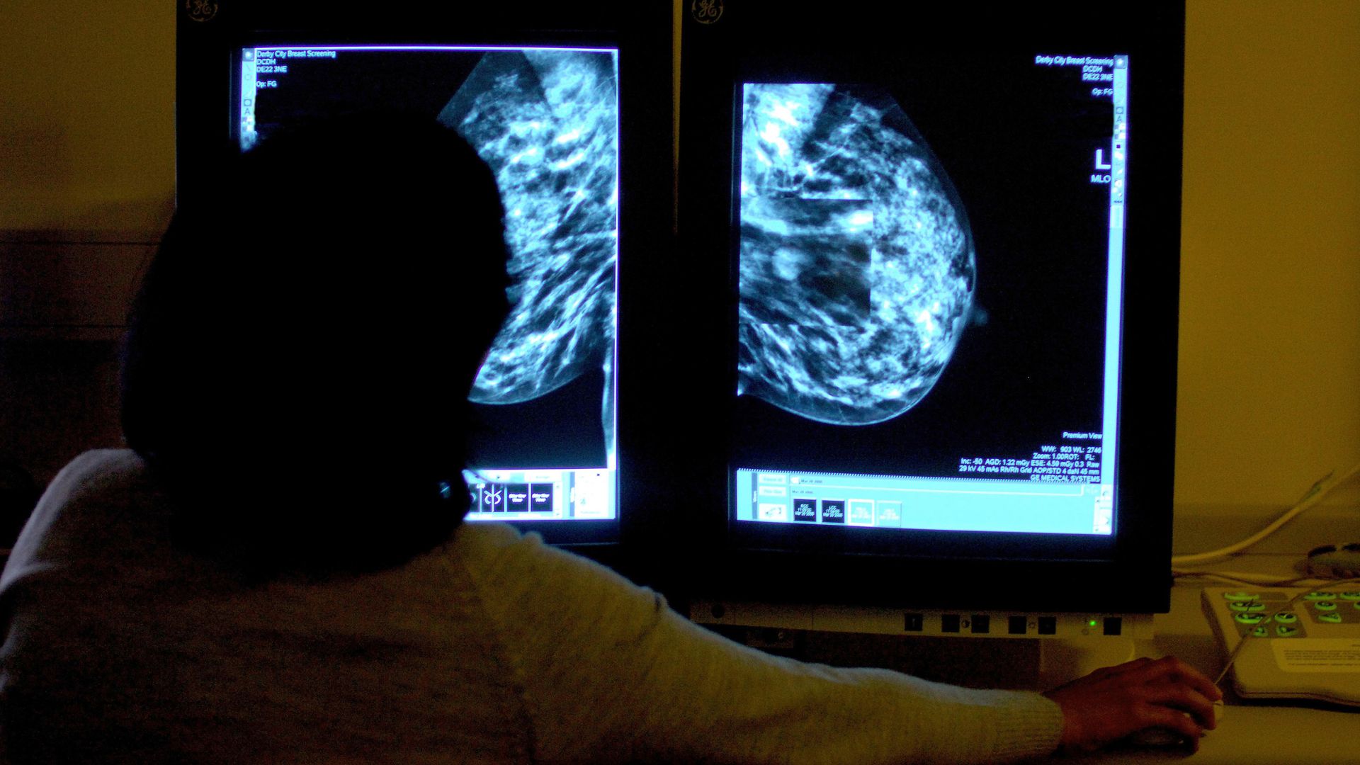 'Transformational' new drug could stop breast cancer tumours before they grow, trial finds