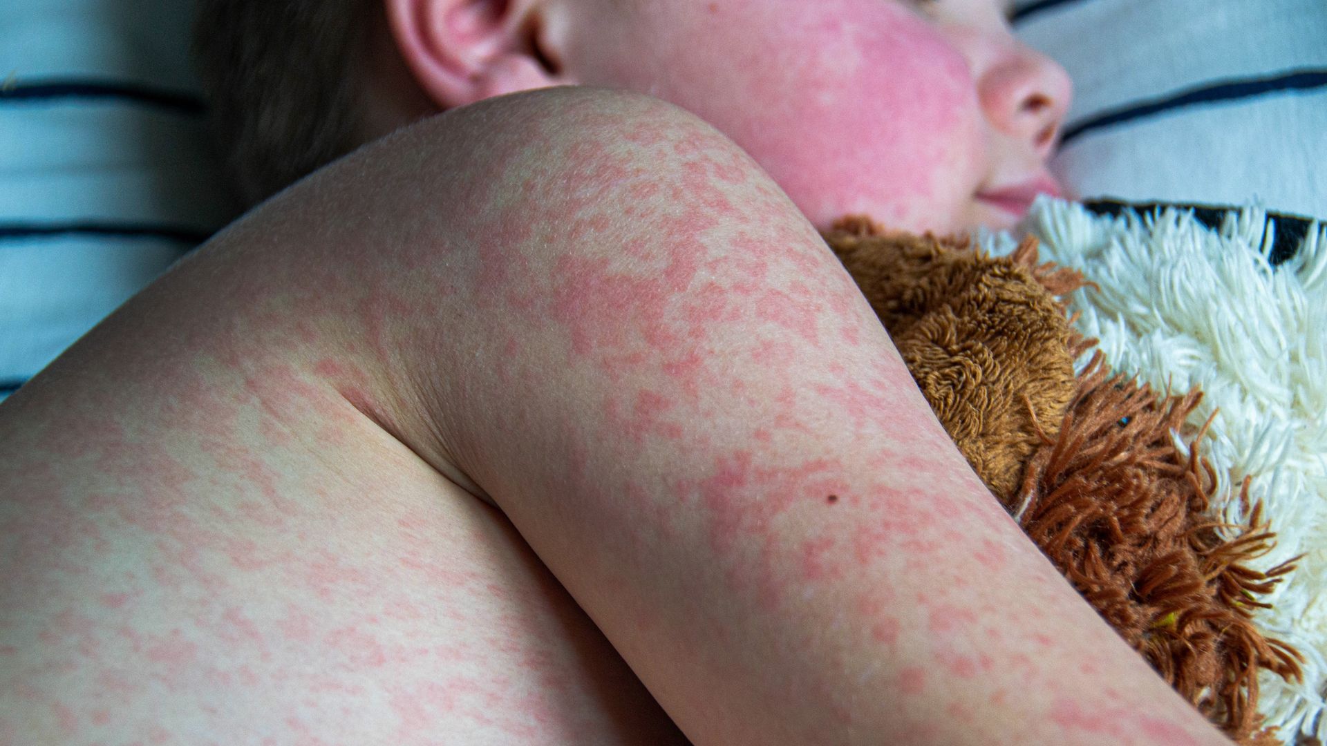UK loses measles elimination status