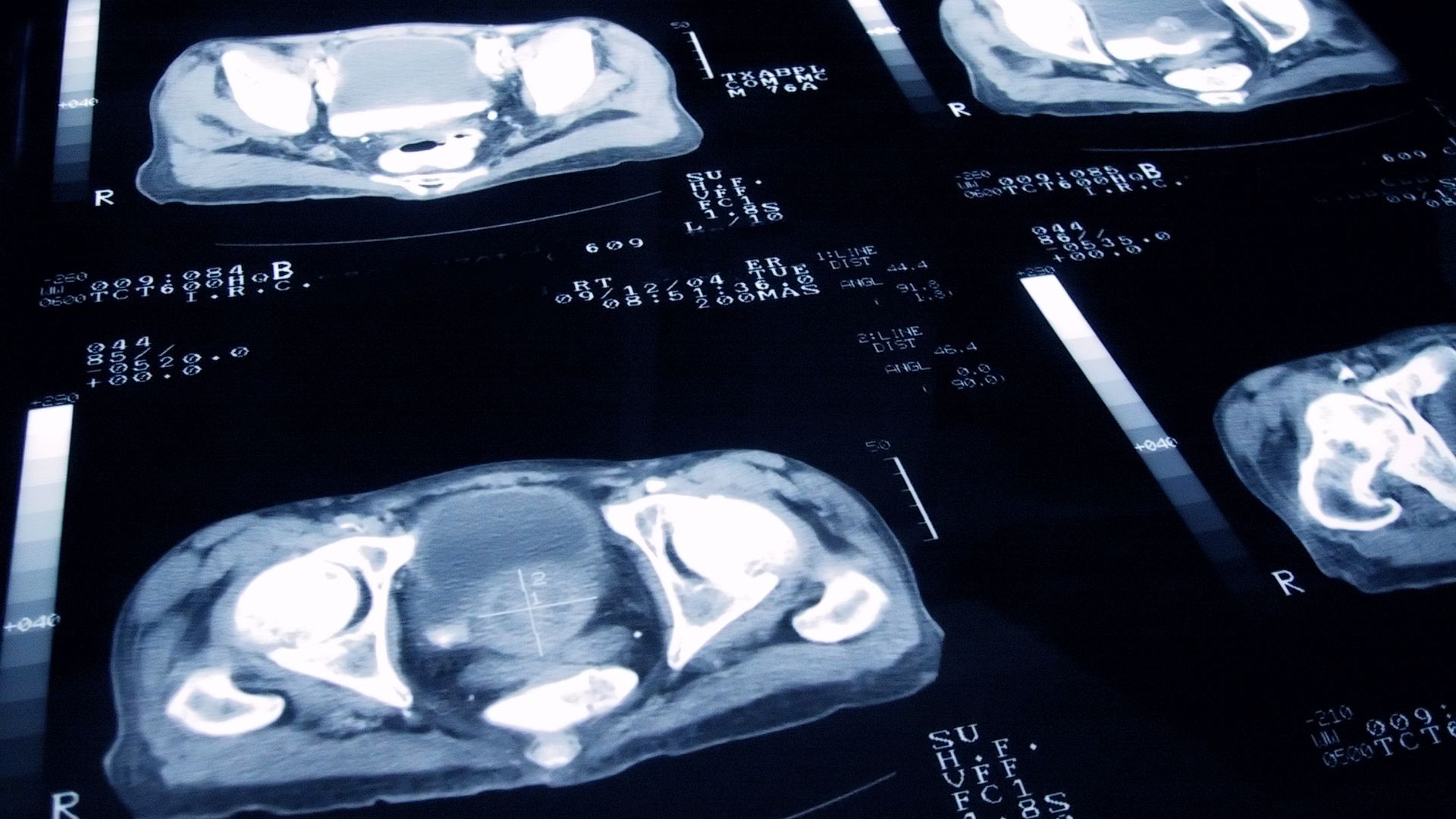 'Missed opportunity' as government rejects call for mass prostate cancer screening